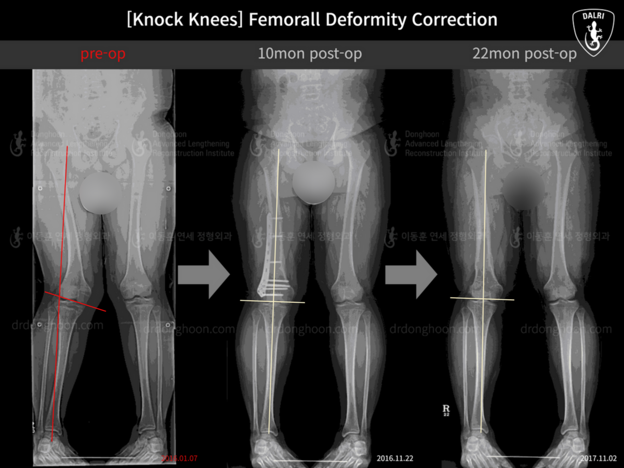 Before and after adult knock knees, case 12760284, image 4, Dr. Donghoon institute (DALRI)