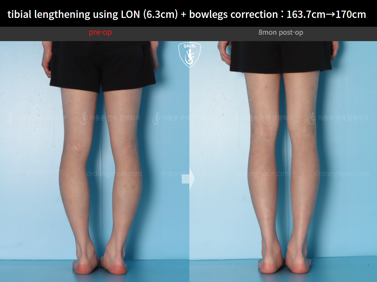 Before and after cll + deformity correction, case 16853829, image 9, Dr. Donghoon institute (DALRI)