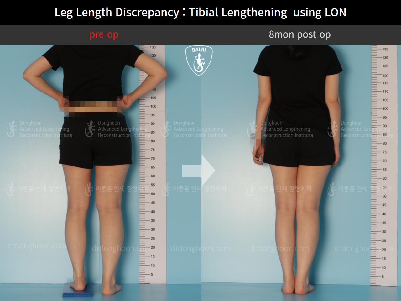Before and after adult lld, case 10477860, image 2, Dr. Donghoon institute (DALRI)