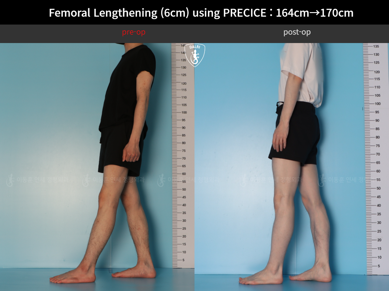 Before and after cll precice, case 33570290, image 5, Dr. Donghoon institute (DALRI)