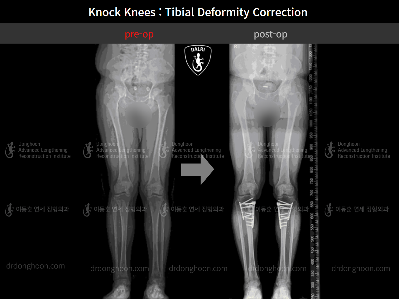 Before and after adult knock knees, case 9393967, image 6, Dr. Donghoon institute (DALRI)