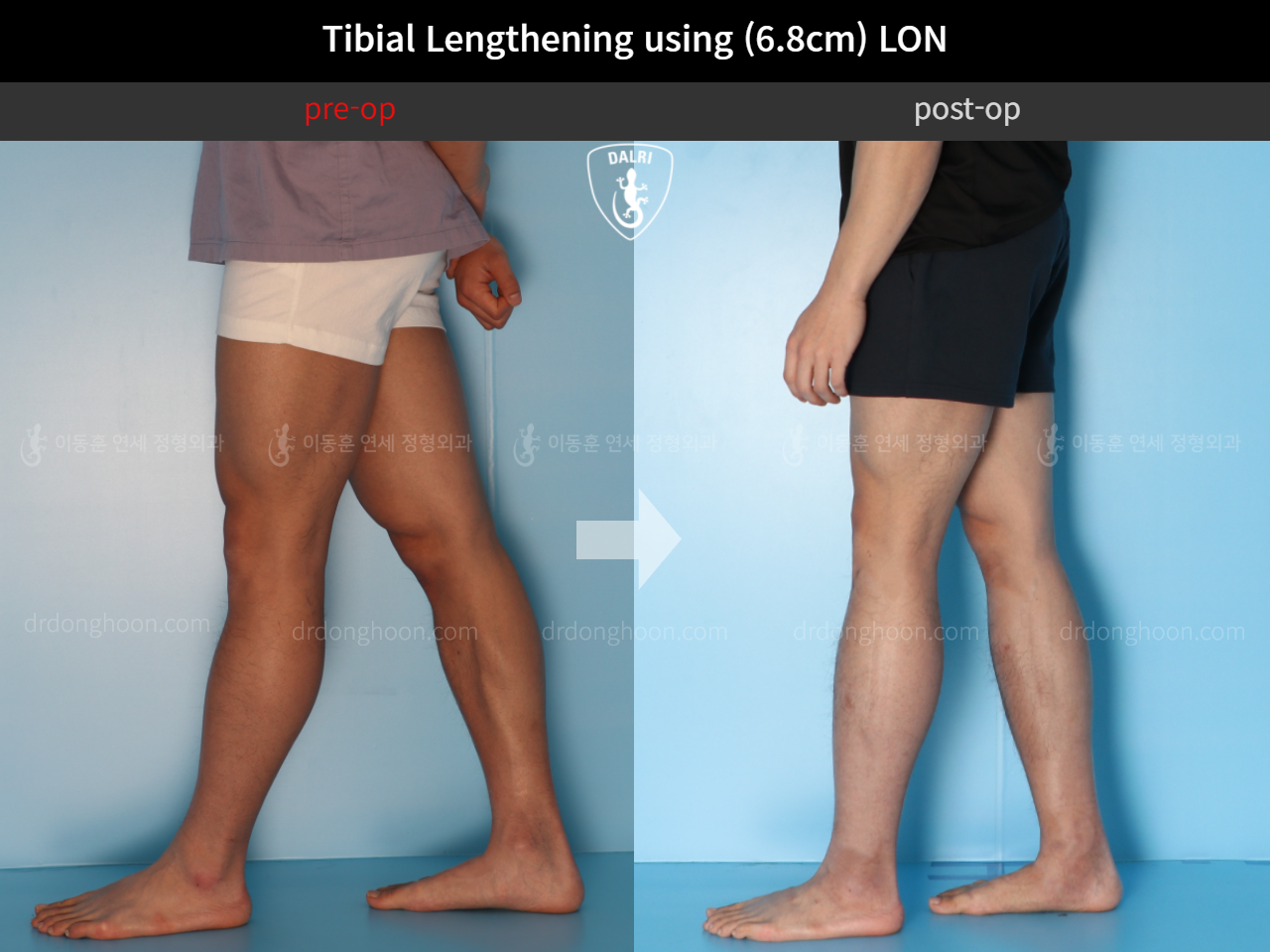 Before and after cll lon, case 4577738, image 7, Dr. Donghoon institute (DALRI)