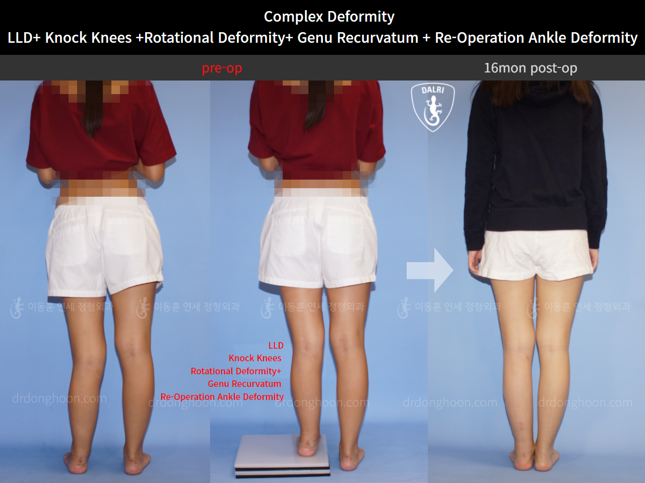 Before and after post-trauma deformity, case 10467603, image 2, Dr. Donghoon institute (DALRI)