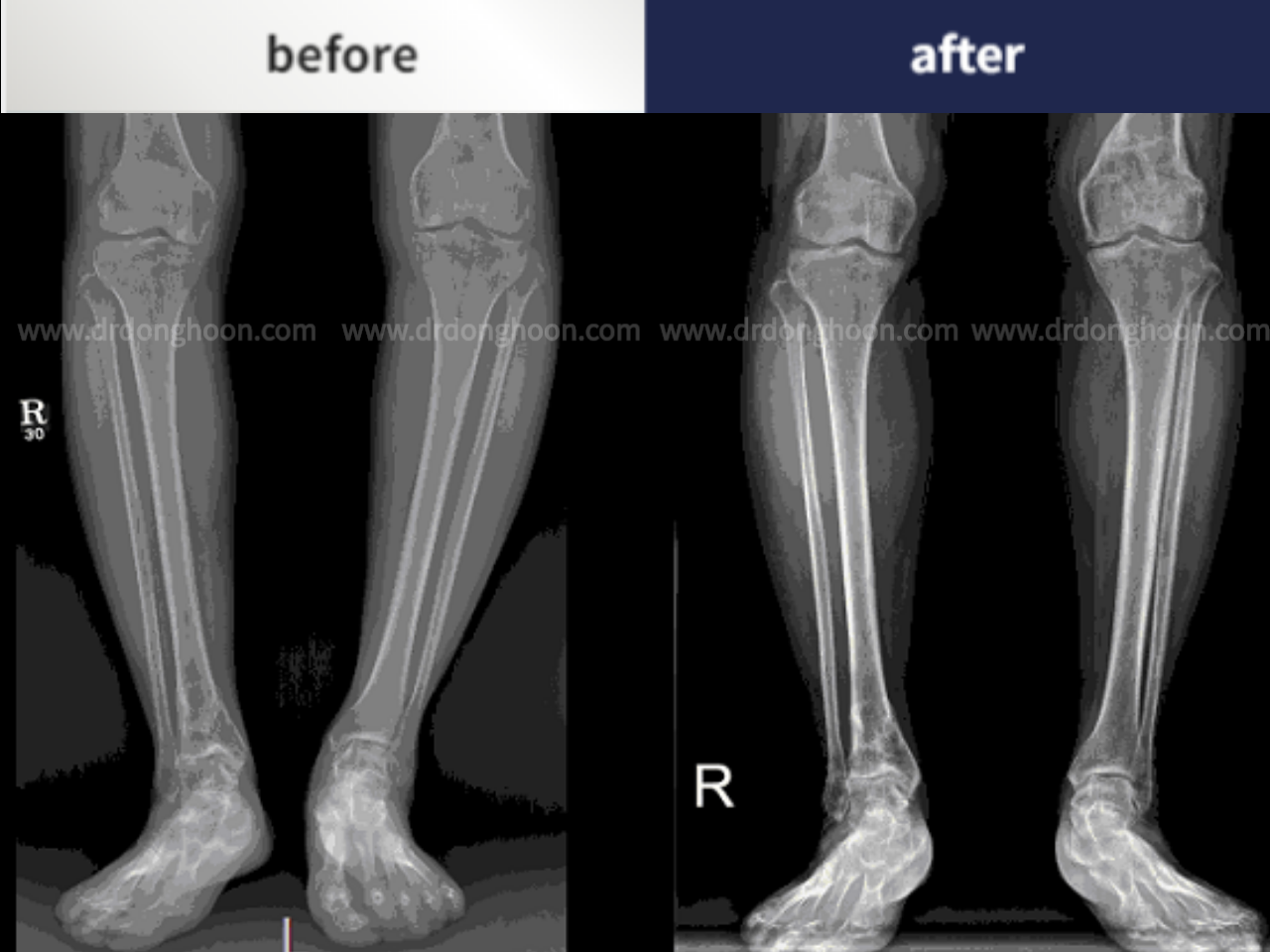 Before and after post-trauma deformity, case 4251782, image 1, Dr. Donghoon institute (DALRI)