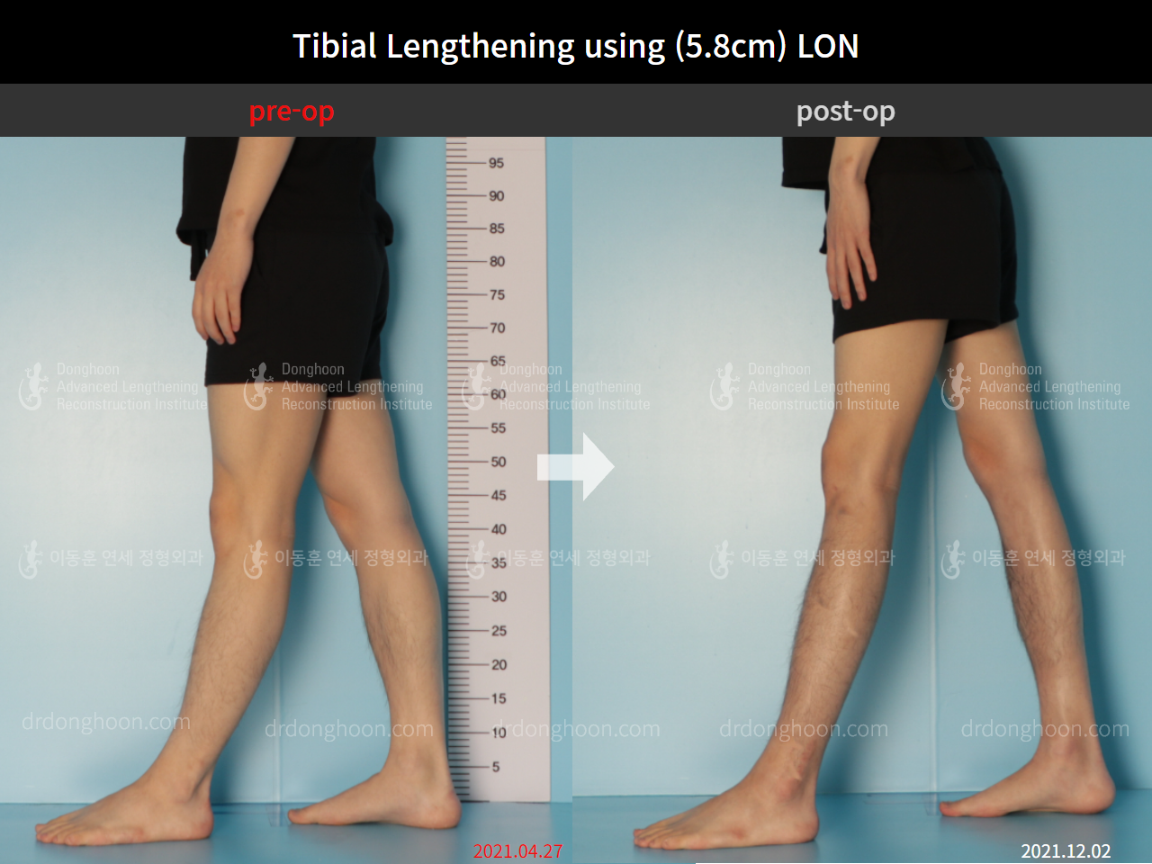 Before and after cll lon, case 9047470, image 6, Dr. Donghoon institute (DALRI)