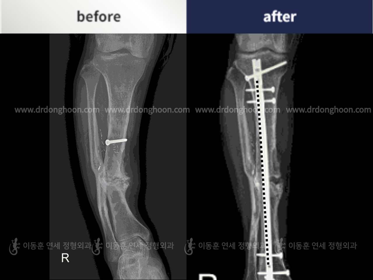 Before and after foot & ankle deformity, case 4248161, image 3, Dr. Donghoon institute (DALRI)