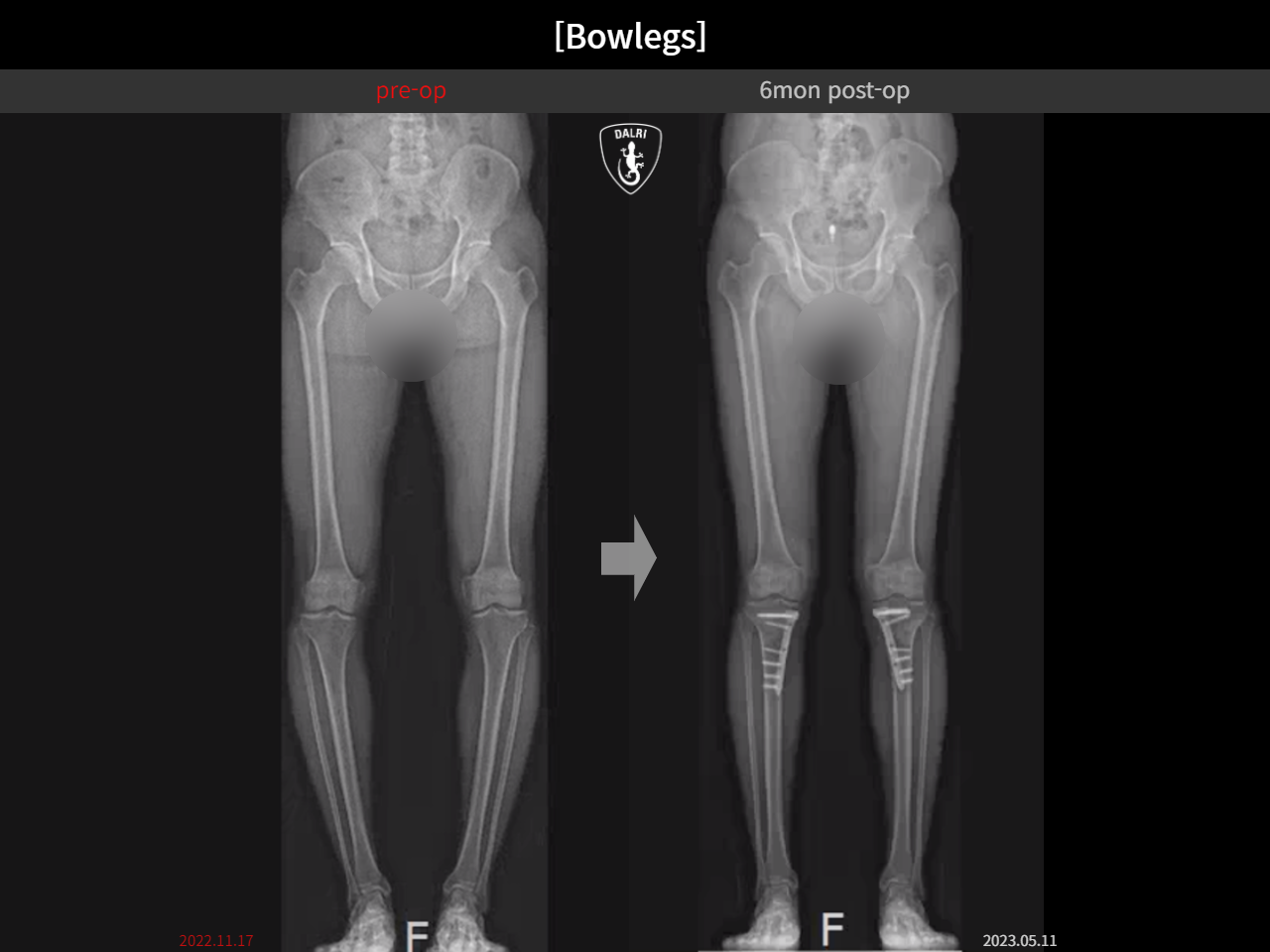 Before and after adult bowlegs, case 15161898, image 2, Dr. Donghoon institute (DALRI)