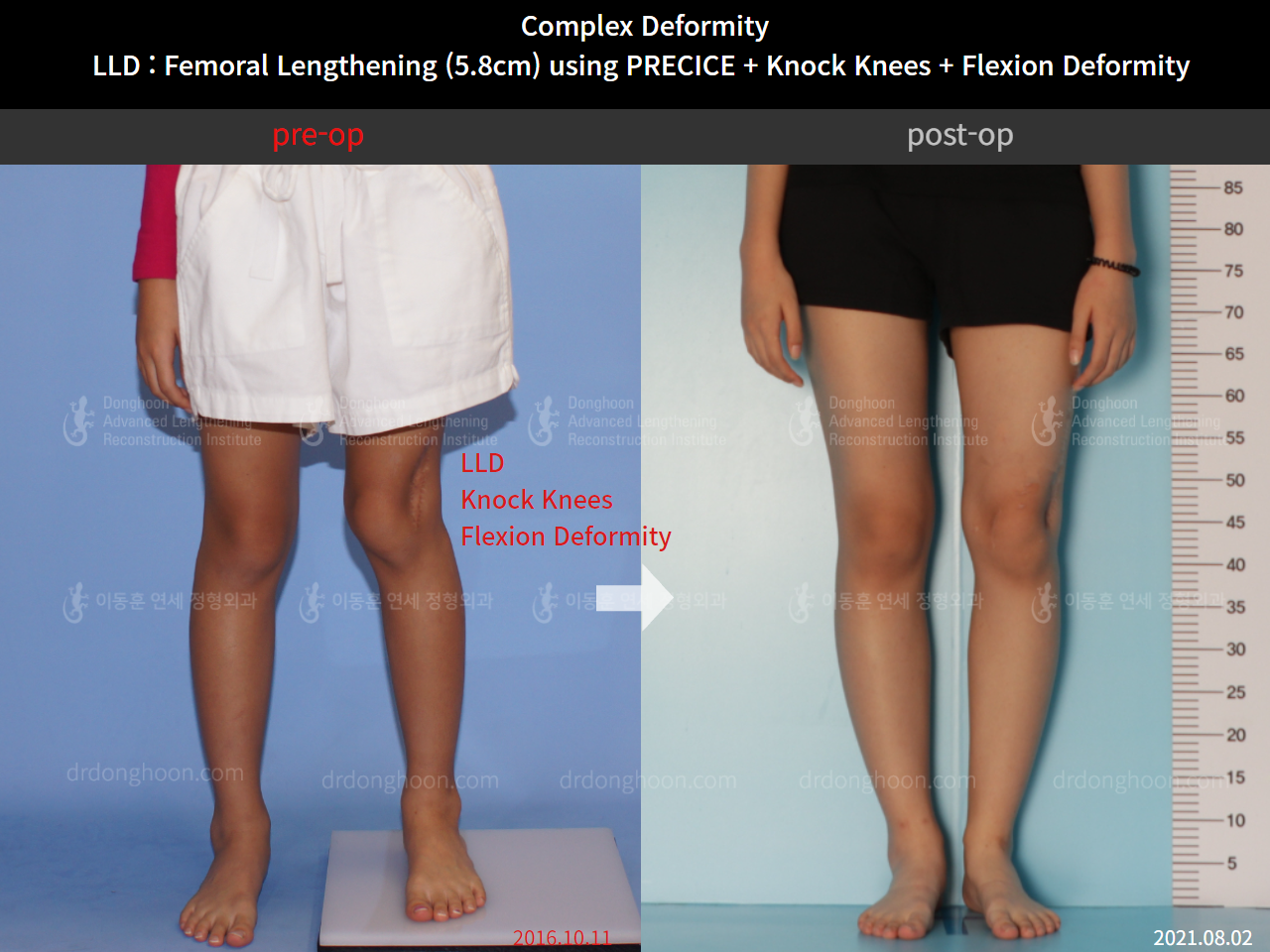 Before and after complex deformity, case 8790512, image 1, Dr. Donghoon institute (DALRI)