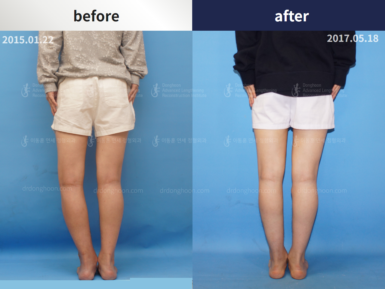 Before and after congenital condition, case 4304662, image 2, Dr. Donghoon institute (DALRI)