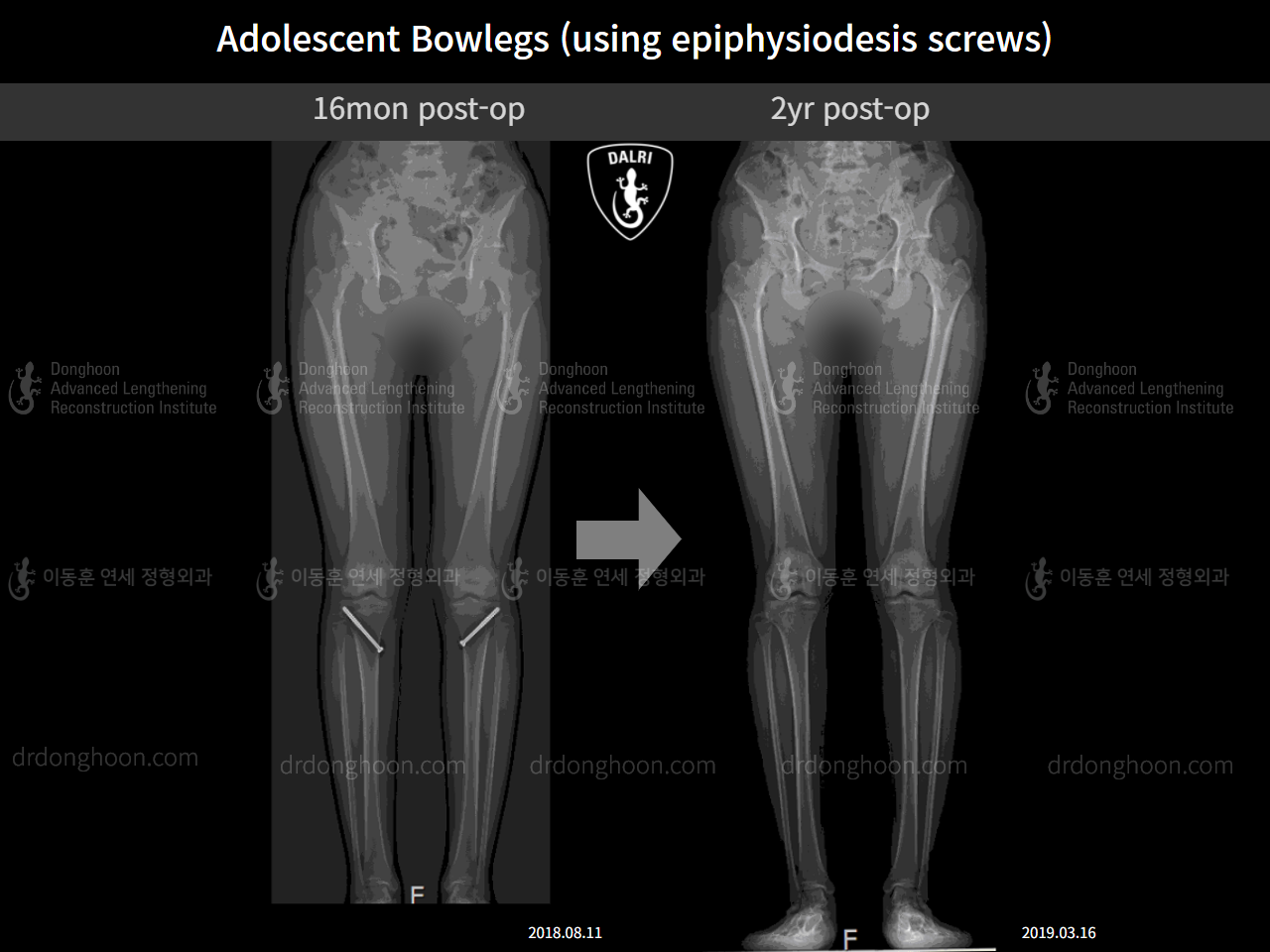 Before and after paediatric & adolescent bowlegs, case 4585777, image 6, Dr. Donghoon institute (DALRI)