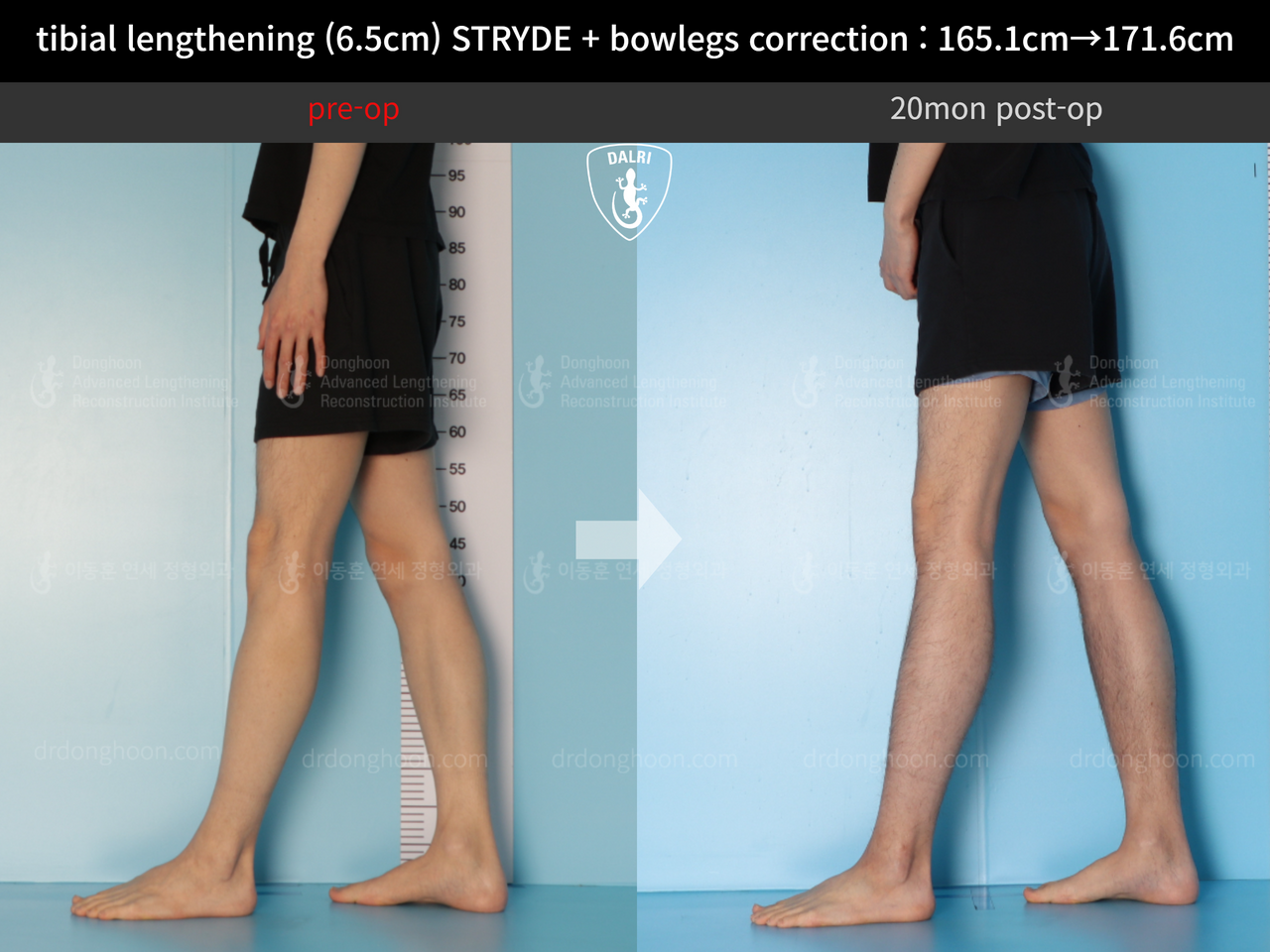 Before and after cll + deformity correction, case 13168253, image 10, Dr. Donghoon institute (DALRI)