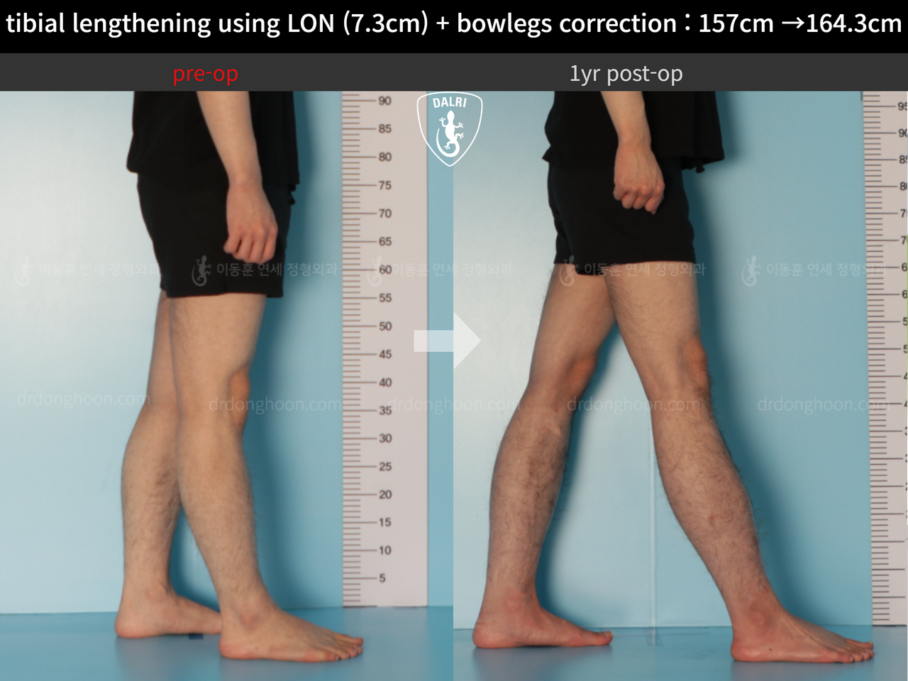 Before and after cll + deformity correction, case 13152543, image 7, Dr. Donghoon institute (DALRI)