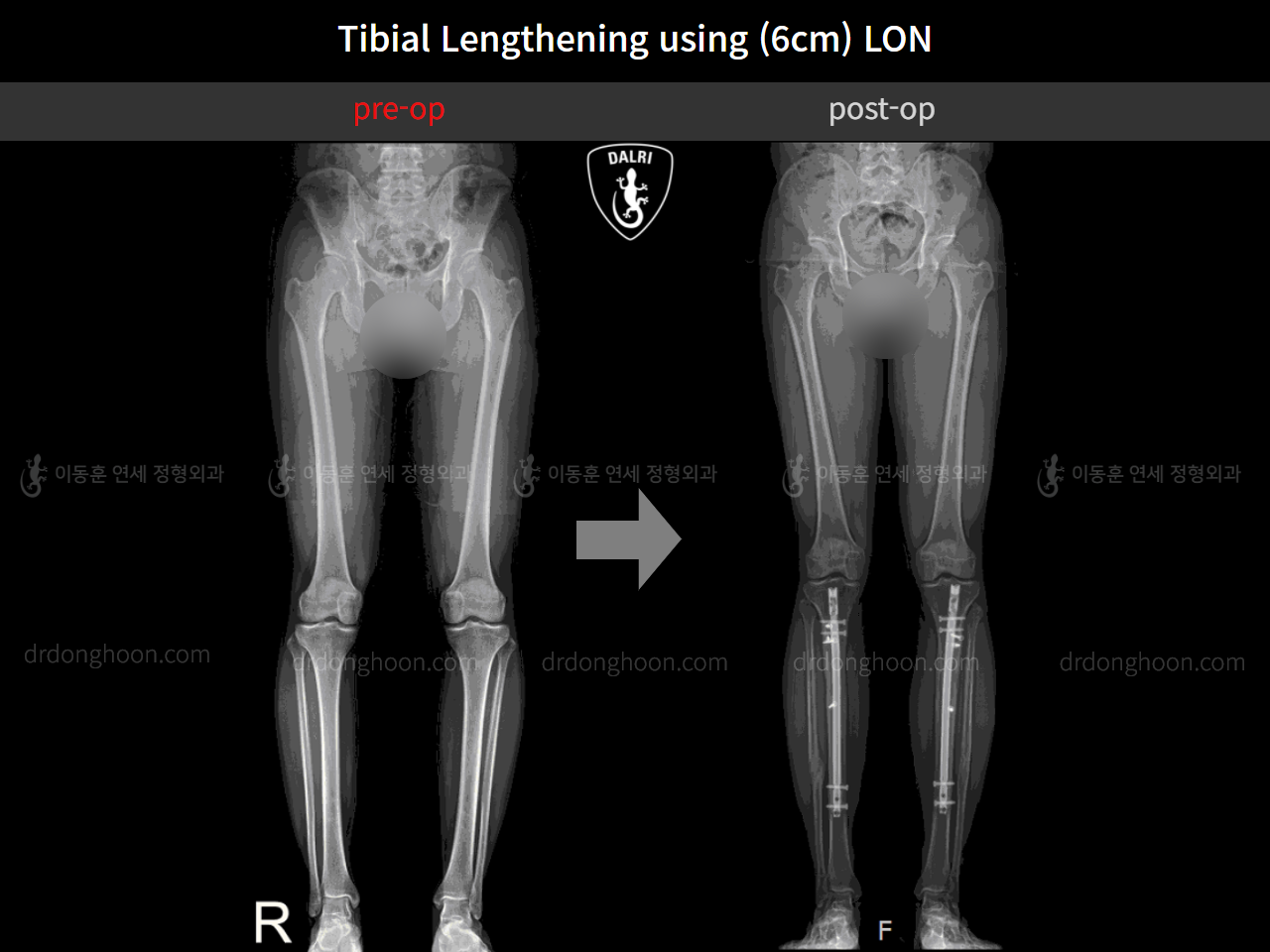 Before and after cll lon, case 4577694, image 9, Dr. Donghoon institute (DALRI)