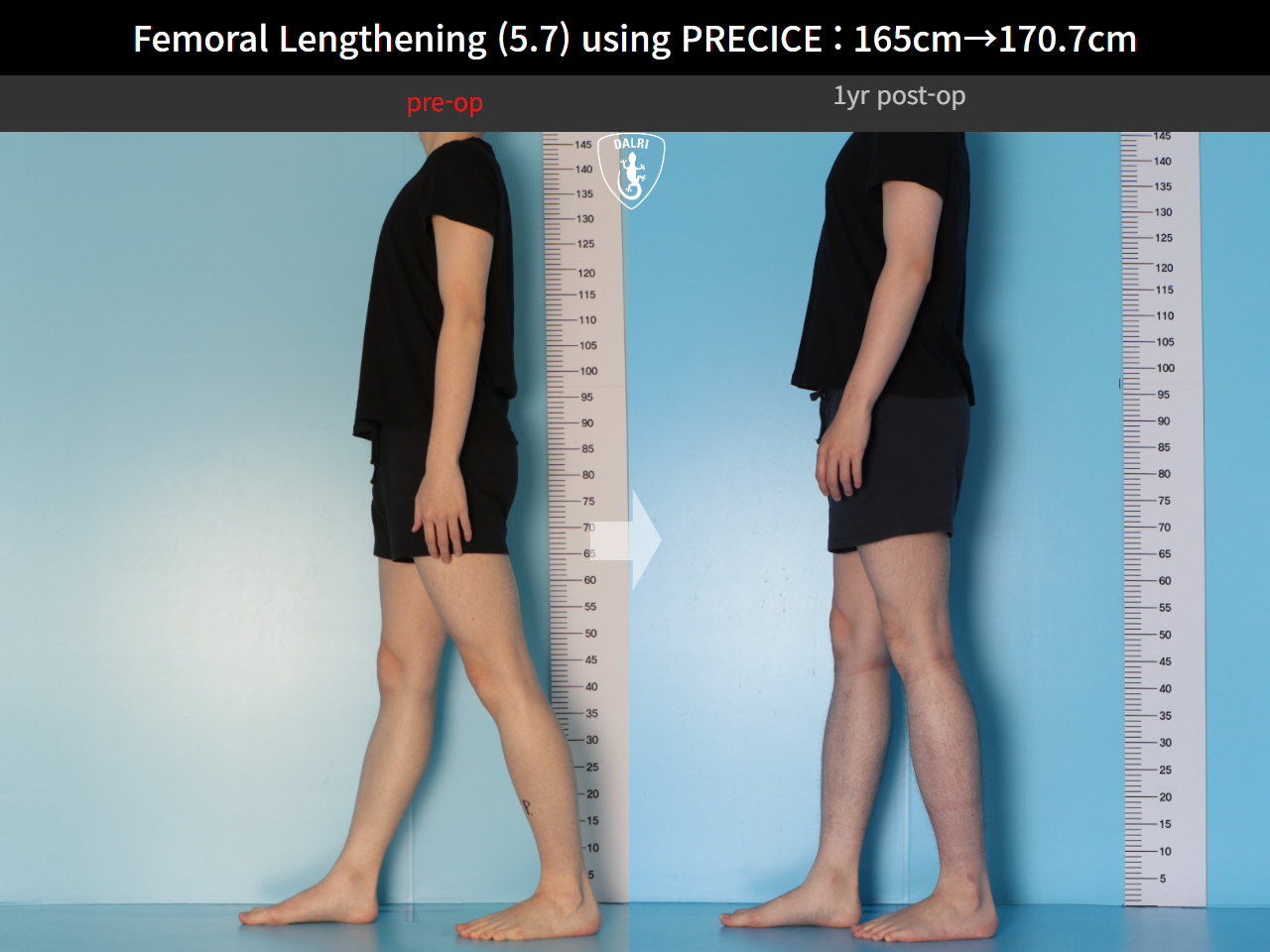 Before and after cll precice, case 15417090, image 6, Dr. Donghoon institute (DALRI)