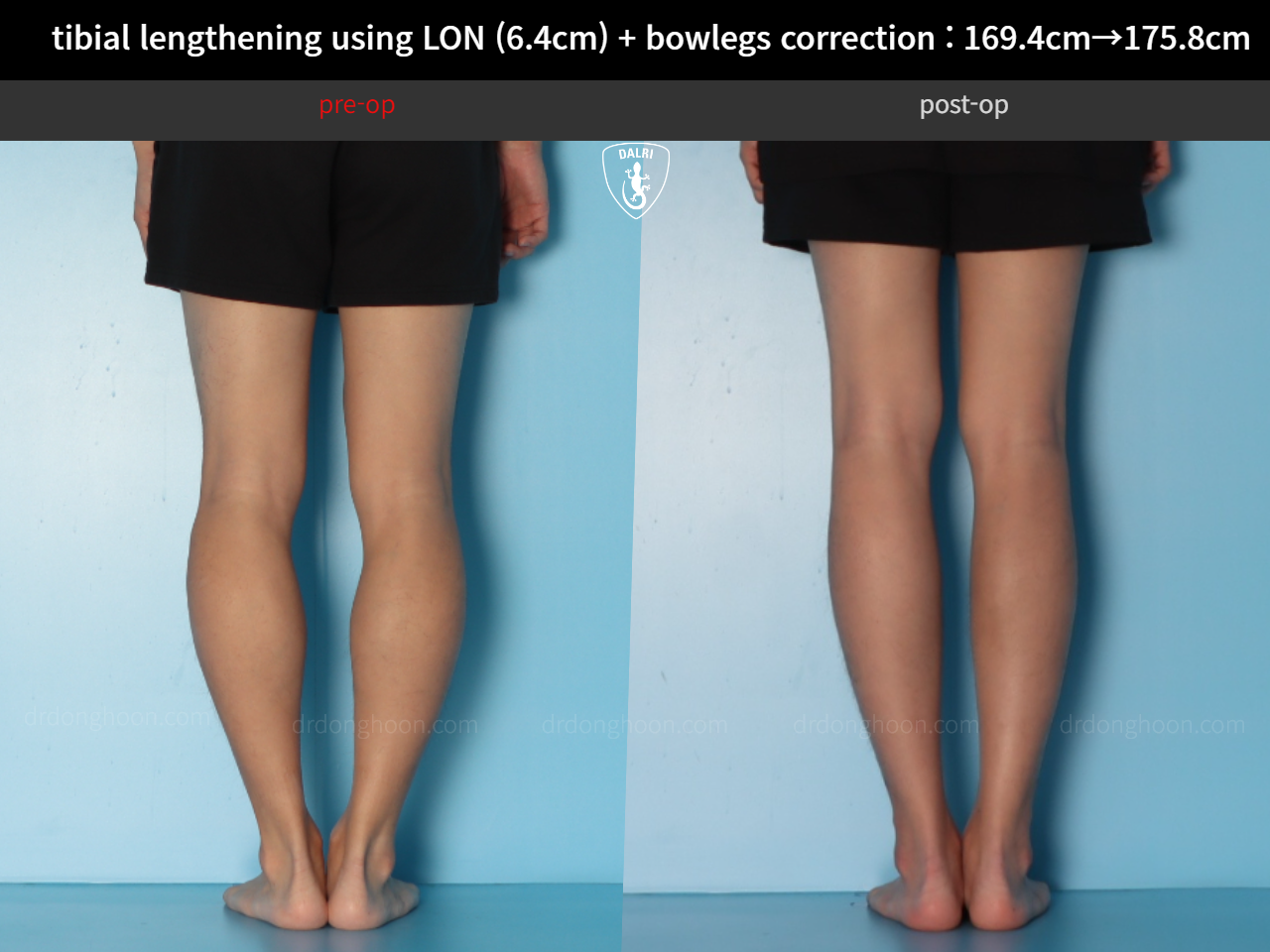 Before and after cll + deformity correction, case 36736776, image 8, Dr. Donghoon institute (DALRI)