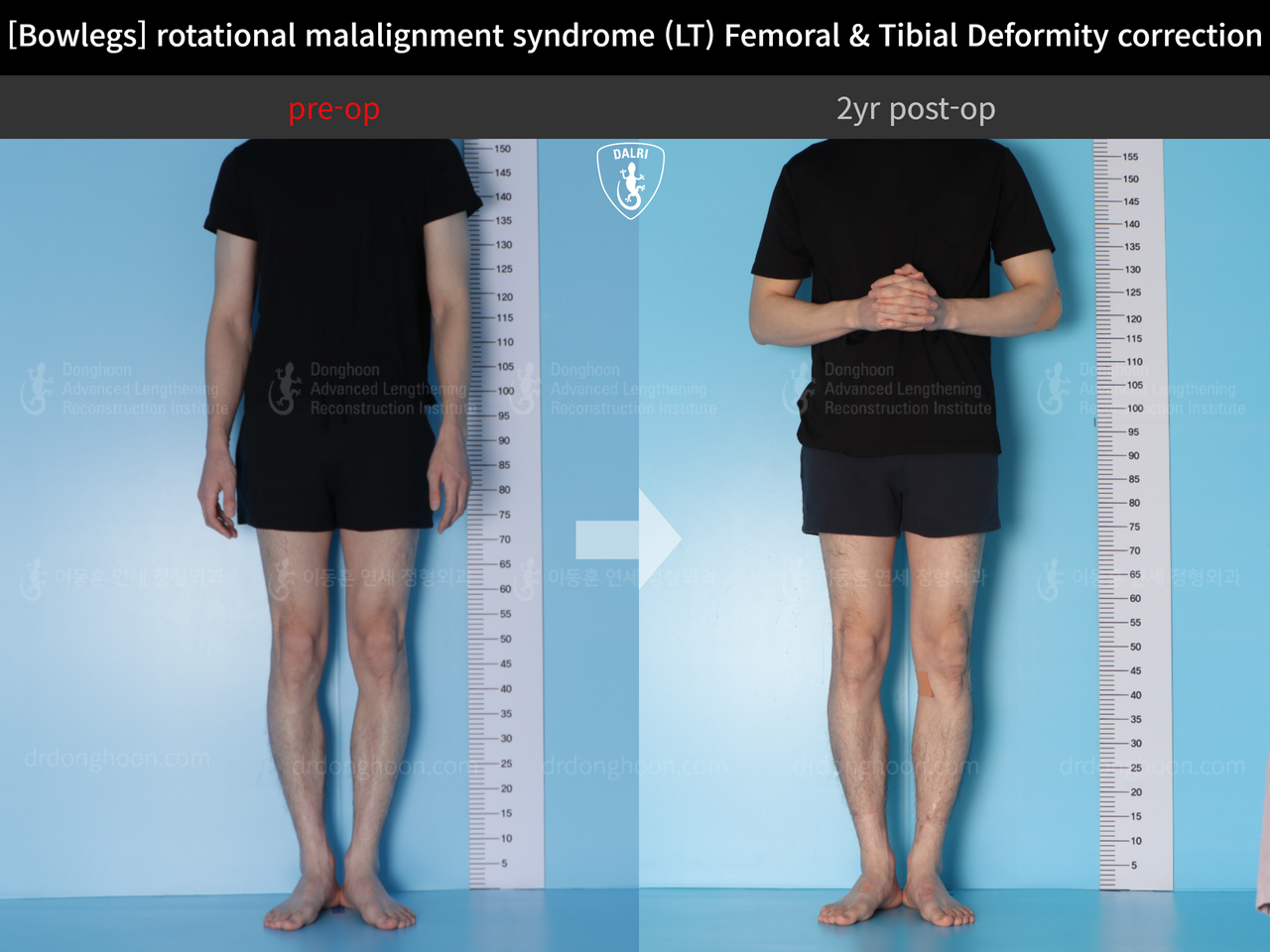 Before and after adult bowlegs, case 13266718, image 4, Dr. Donghoon institute (DALRI)