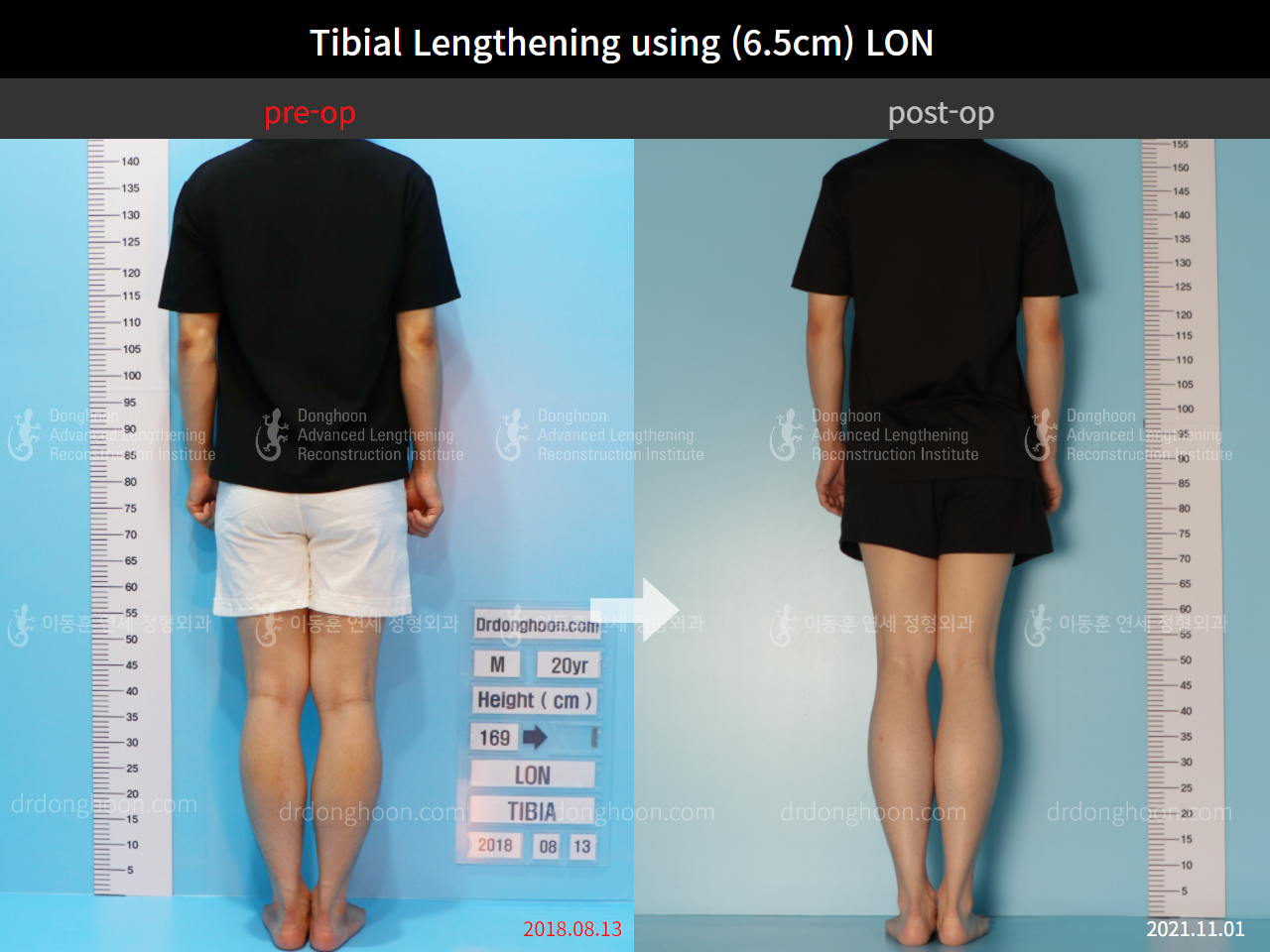 Before and after cll lon, case 8777040, image 2, Dr. Donghoon institute (DALRI)
