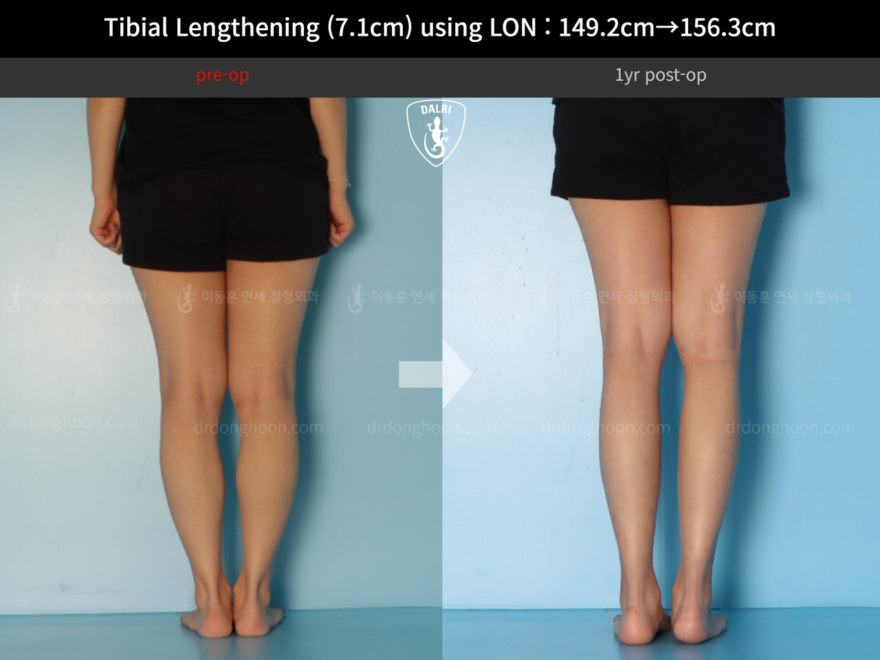 Before and after cll lon, case 14264800, image 6, Dr. Donghoon institute (DALRI)