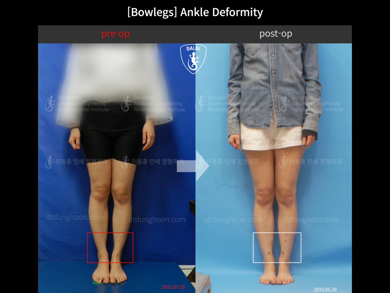 Before and after foot & ankle deformity, case 12754696, image 2, Dr. Donghoon institute (DALRI)