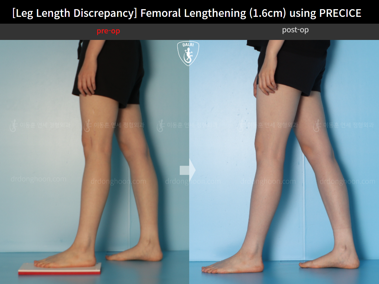Before and after adult lld, case 15705968, image 9, Dr. Donghoon institute (DALRI)
