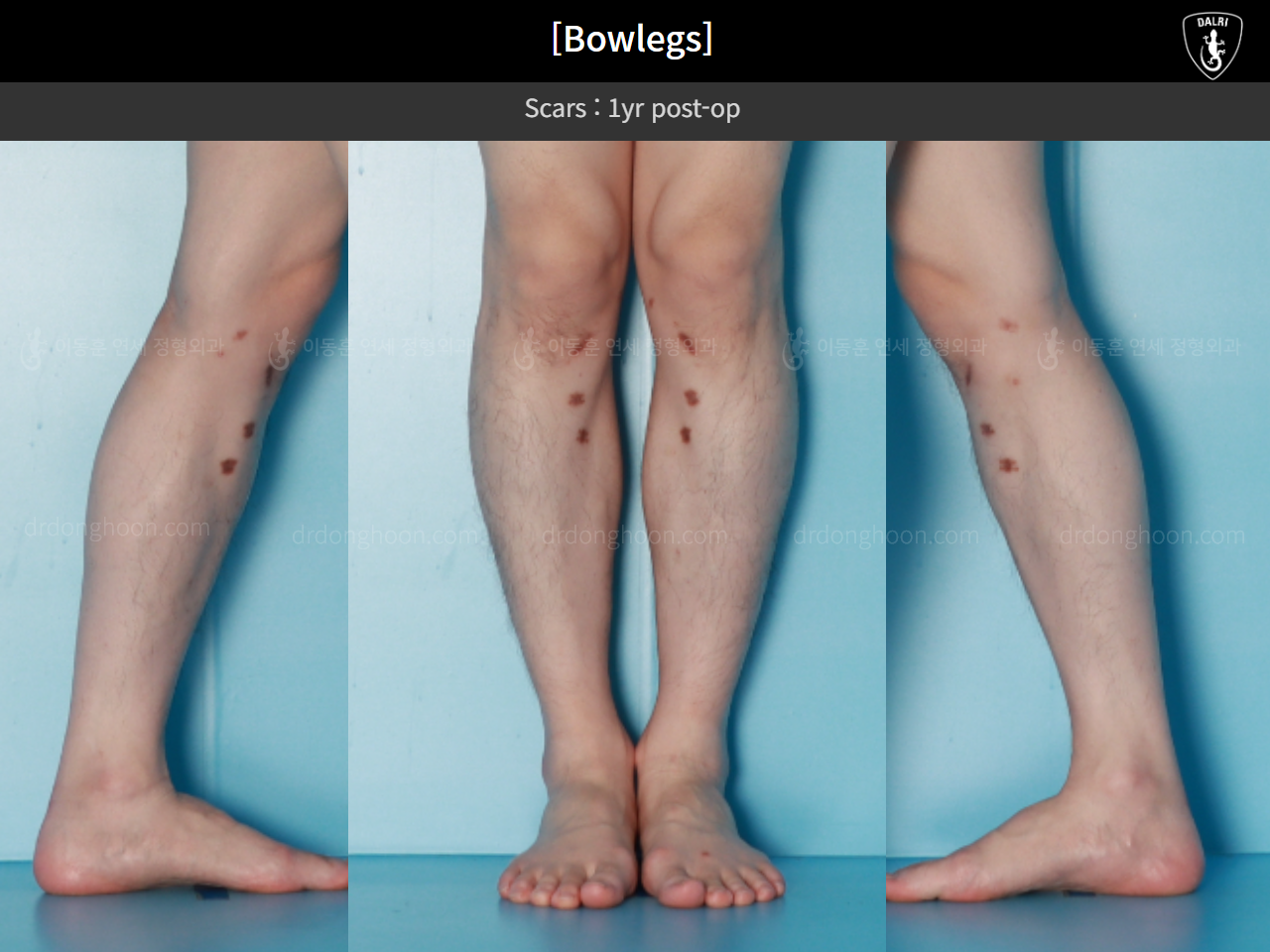 Before and after adult bowlegs, case 16724494, image 11, Dr. Donghoon institute (DALRI)
