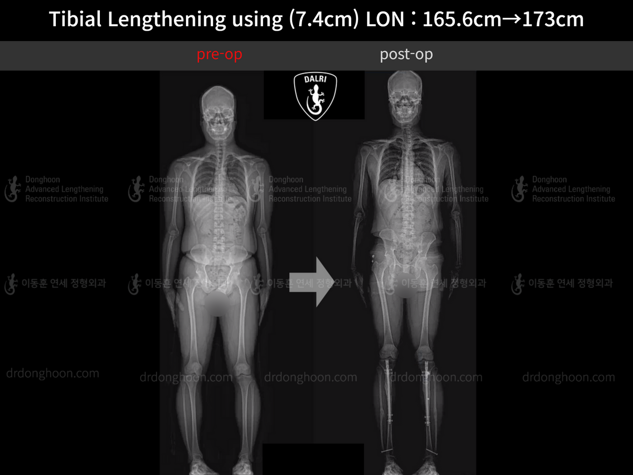 Before and after cll lon, case 13634644, image 9, Dr. Donghoon institute (DALRI)