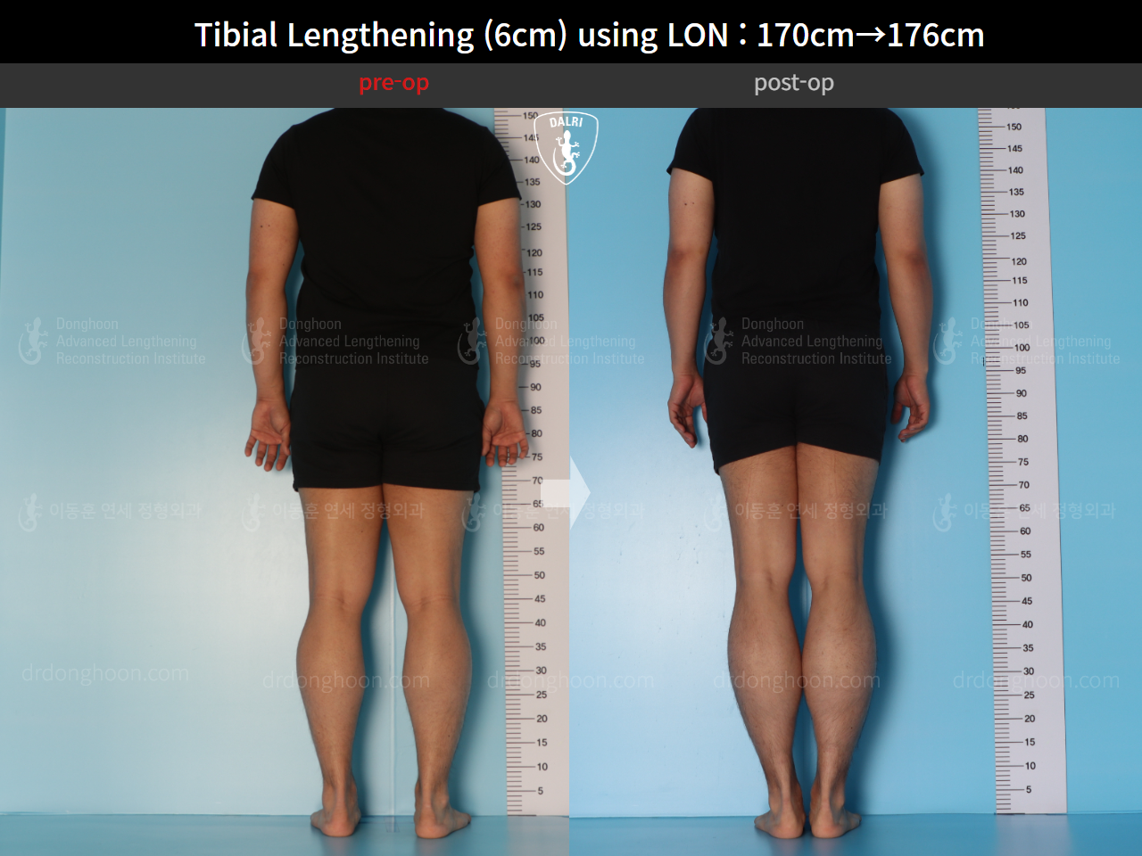 Before and after cll lon, case 15623962, image 3, Dr. Donghoon institute (DALRI)