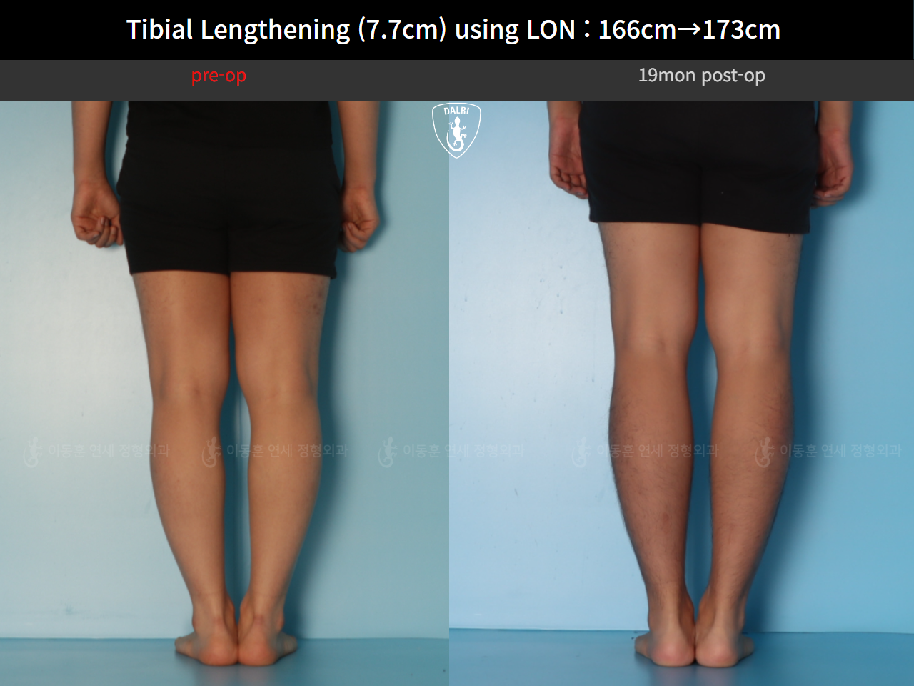 Before and after cll lon, case 126858222, image 6, Dr. Donghoon institute (DALRI)