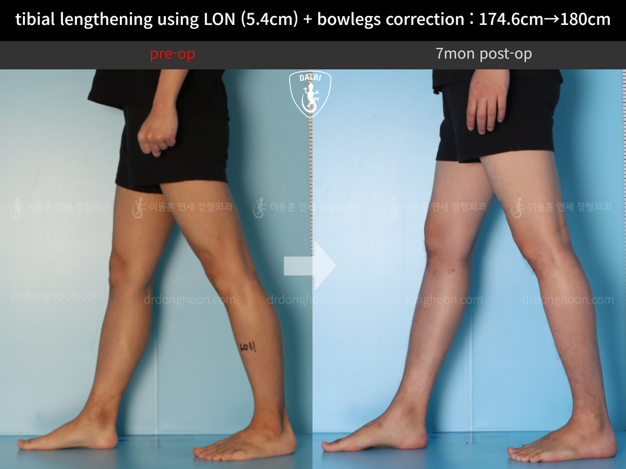 Before and after cll + deformity correction, case 12718558, image 10, Dr. Donghoon institute (DALRI)