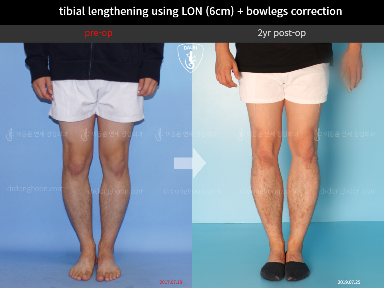 Before and after cll + deformity correction, case 4323155, image 5, Dr. Donghoon institute (DALRI)