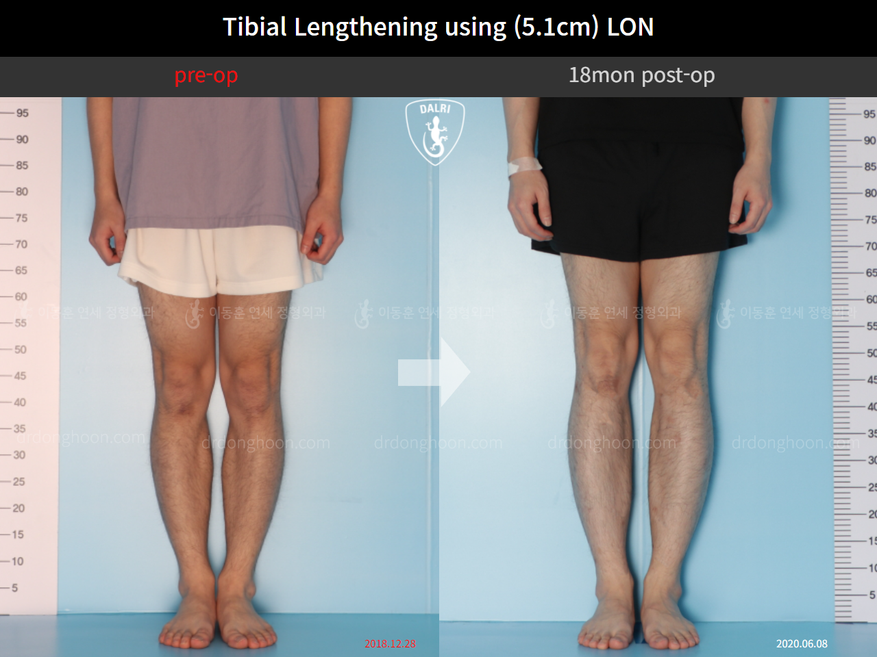 Before and after cll lon, case 9657314, image 5, Dr. Donghoon institute (DALRI)