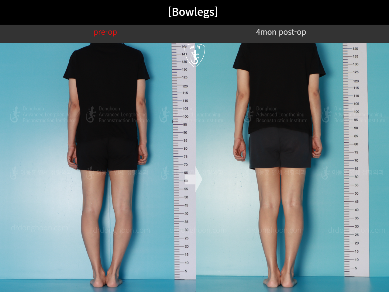 Before and after adult bowlegs, case 17962599, image 4, Dr. Donghoon institute (DALRI)