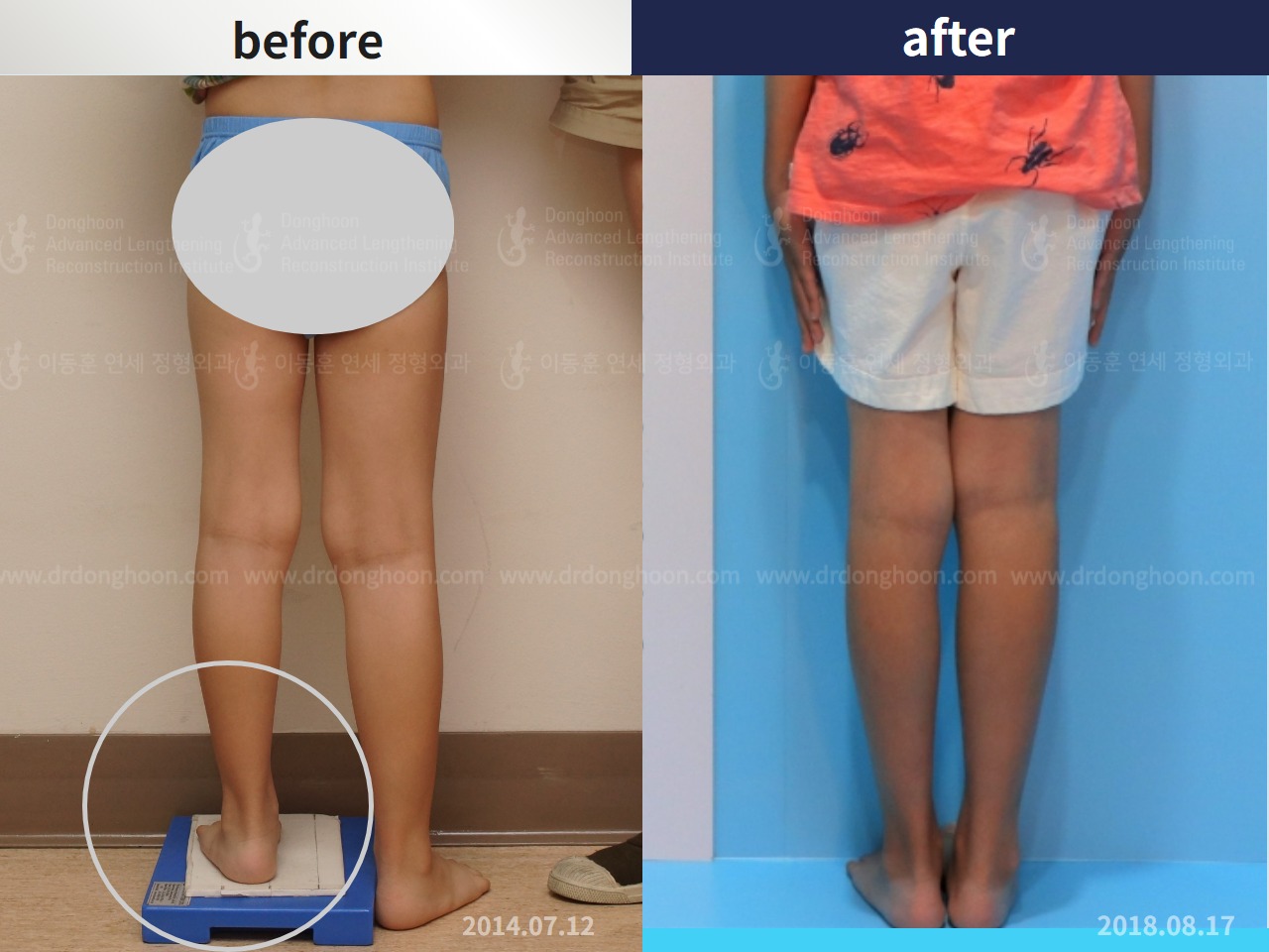 Before and after paediatric & adolescent lld, case 4320426, image 2, Dr. Donghoon institute (DALRI)
