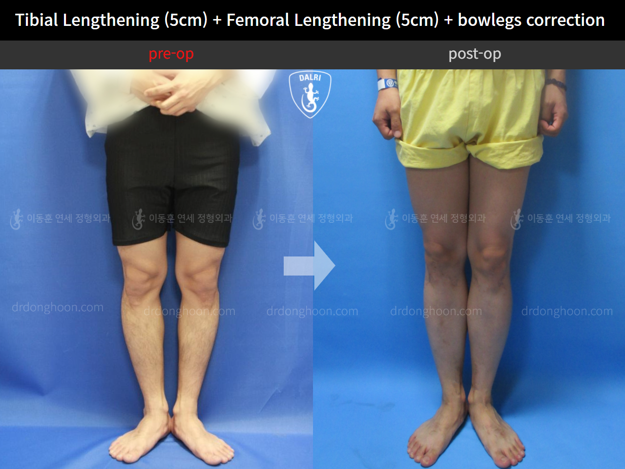 Before and after cll + deformity correction, case 4323174, image 4, Dr. Donghoon institute (DALRI)