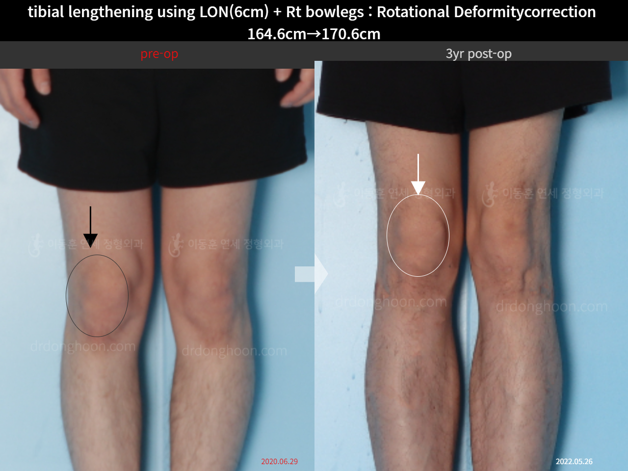 Before and after cll + deformity correction, case 15347322, image 6, Dr. Donghoon institute (DALRI)