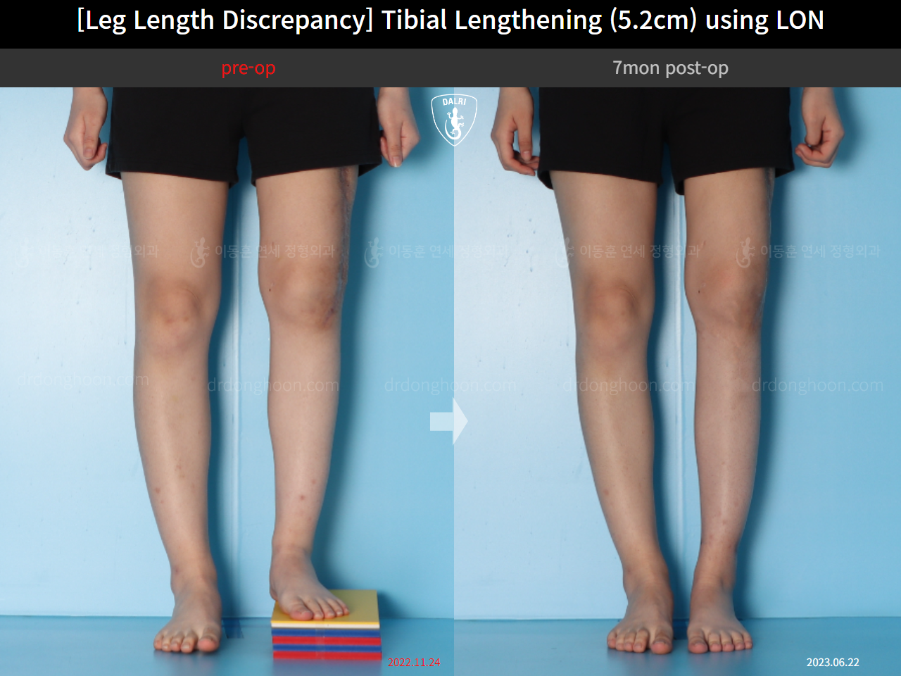 Before and after adult lld, case 16539955, image 4, Dr. Donghoon institute (DALRI)