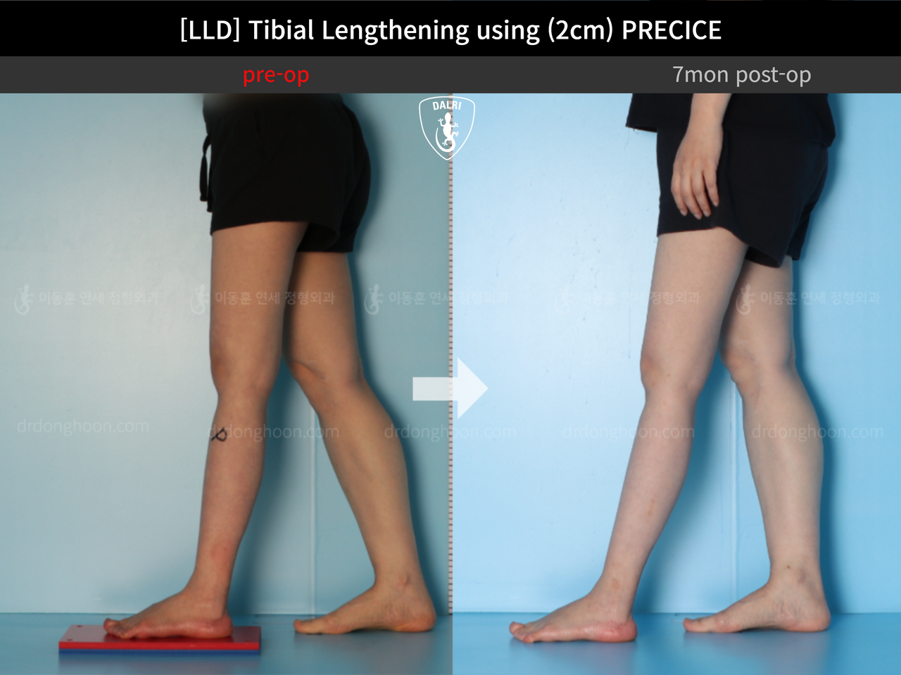 Before and after adult lld, case 12985023, image 7, Dr. Donghoon institute (DALRI)