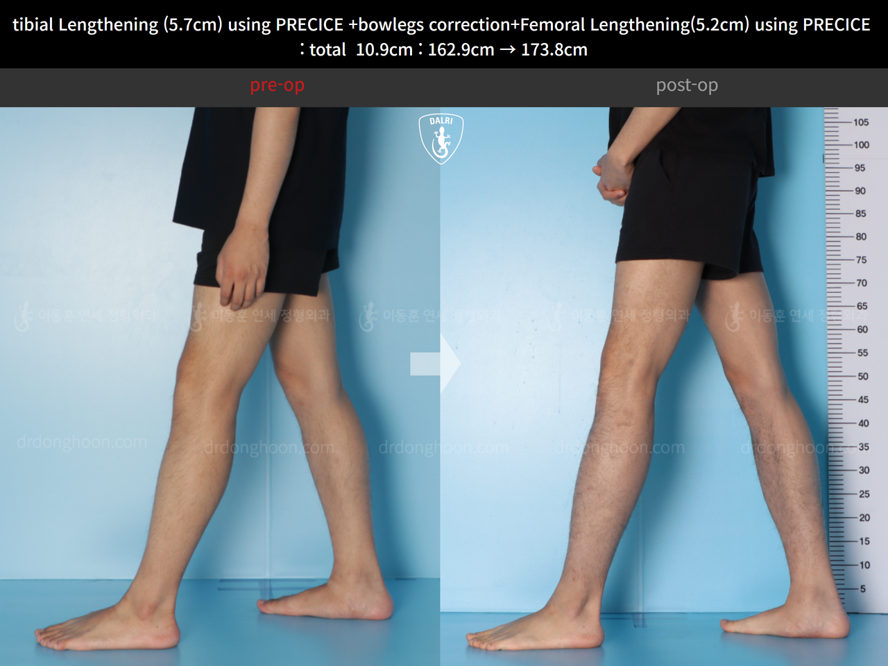 Before and after cll + deformity correction, case 13924912, image 8, Dr. Donghoon institute (DALRI)