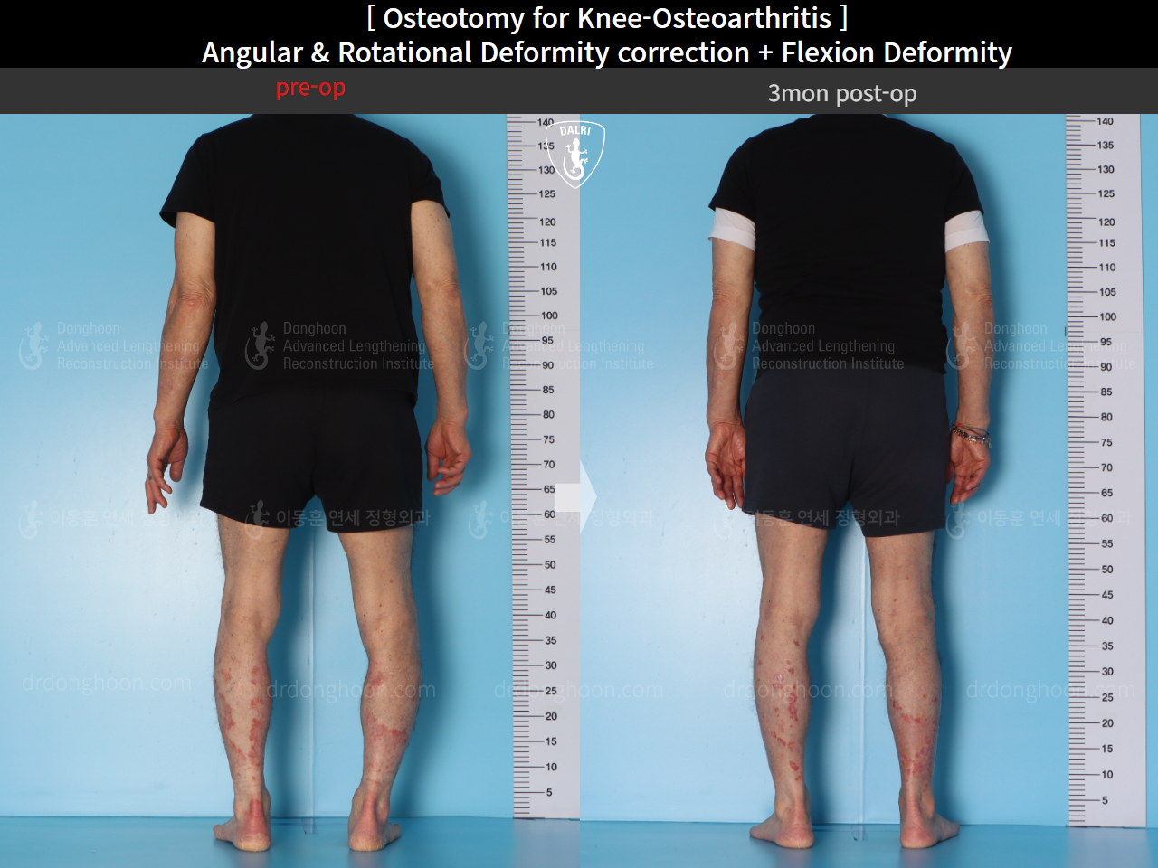 Before and after osteotomy for knee osteoarthritis, case 15362950, image 6, Dr. Donghoon institute (DALRI)