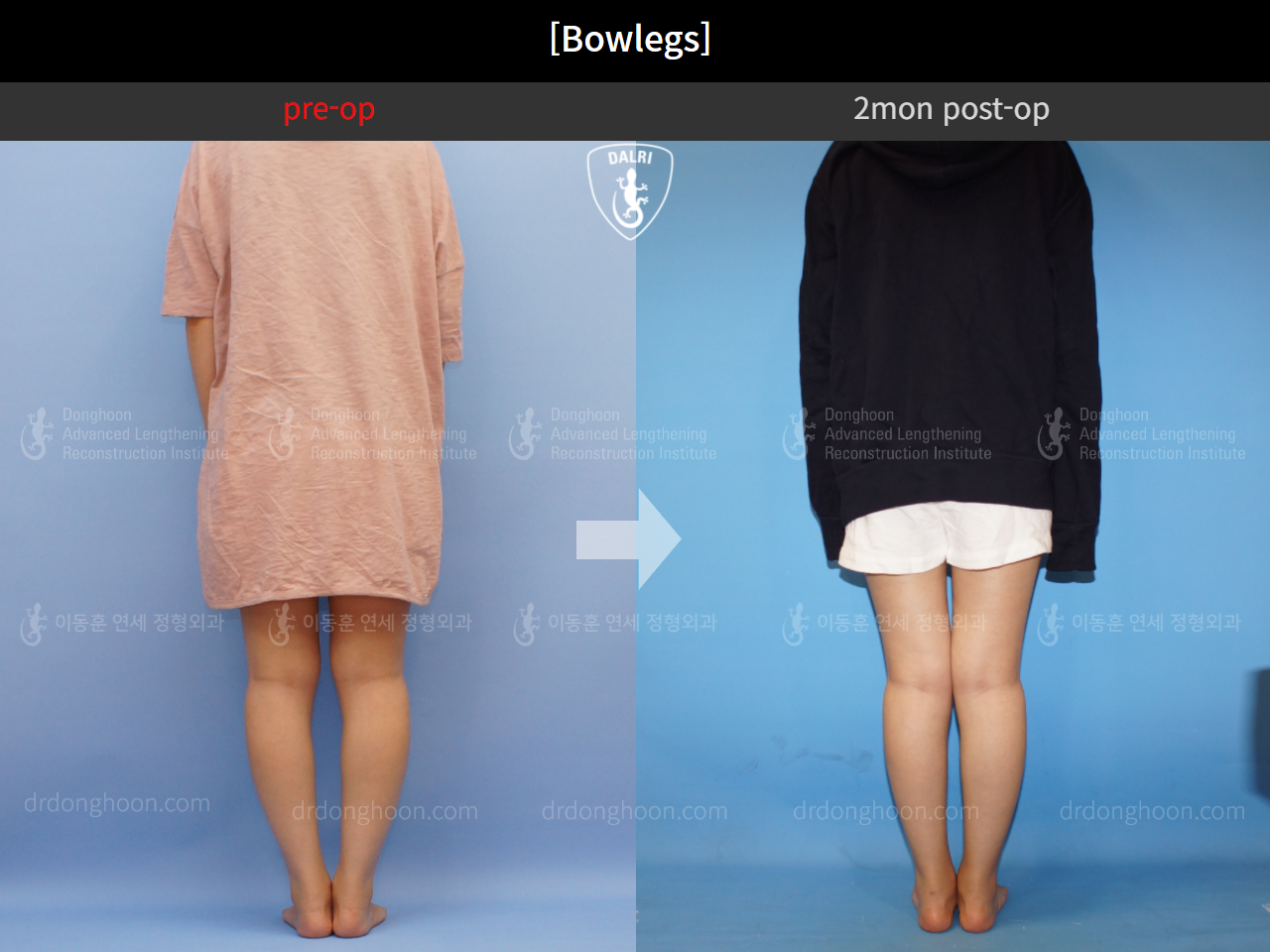Adult Bowlegs 2mon postop Adult Bowlegs