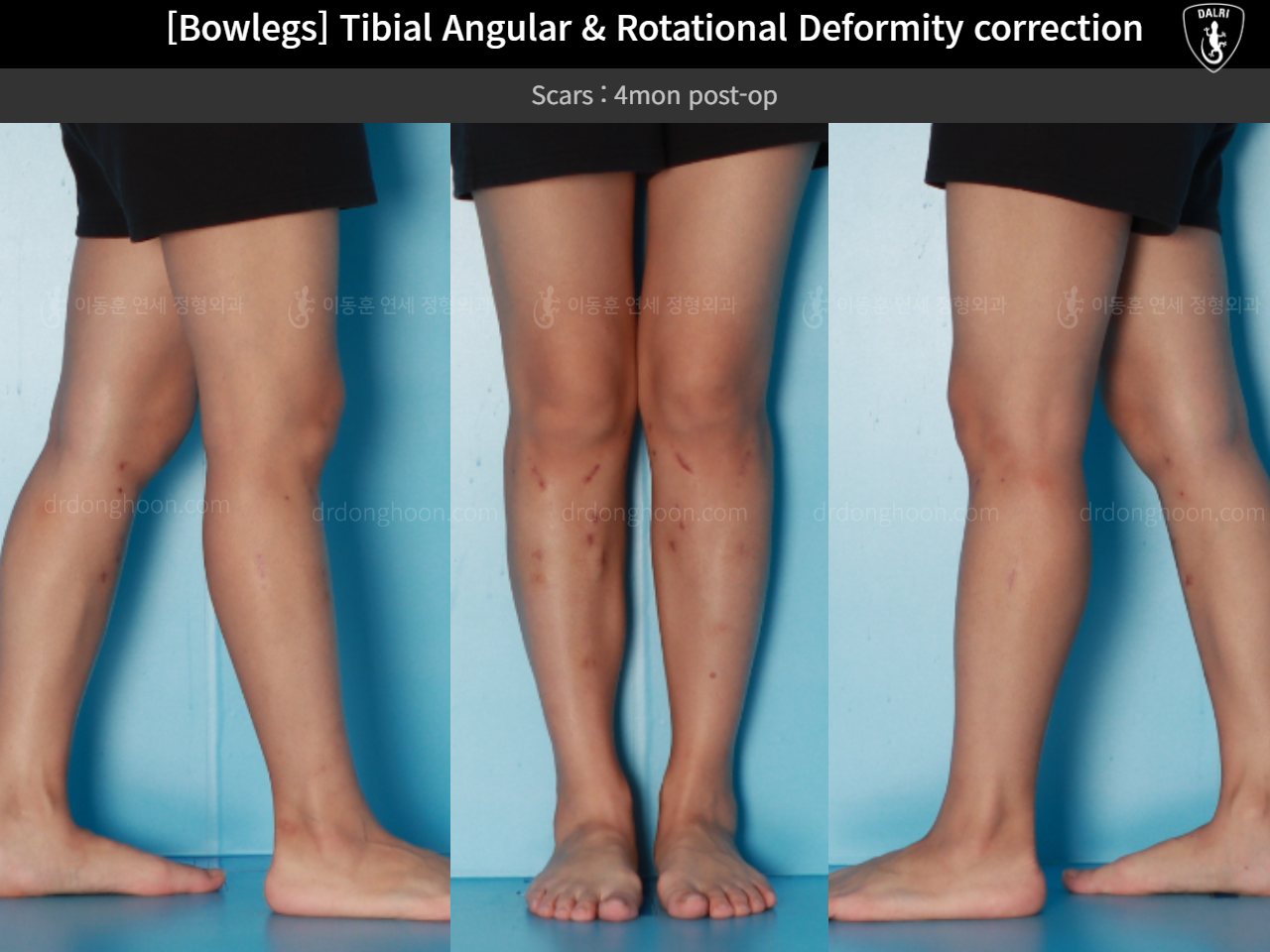 Before and after adult bowlegs, case 16530390, image 11, Dr. Donghoon institute (DALRI)