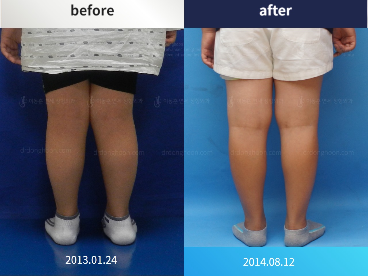 Before and after paediatric & adolescent knock knees, case 4310927, image 2, Dr. Donghoon institute (DALRI)