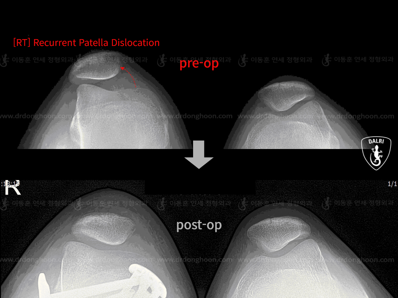 Before and after recurrent patella dislocation, case 9159612, image 4, Dr. Donghoon institute (DALRI)