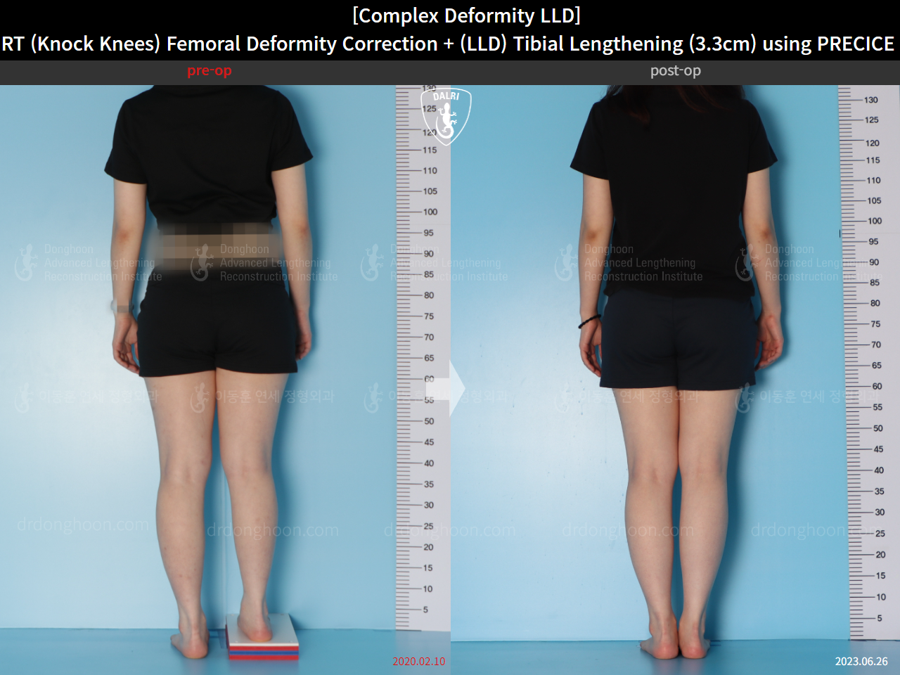 Before and after adult lld, case 15584036, image 2, Dr. Donghoon institute (DALRI)