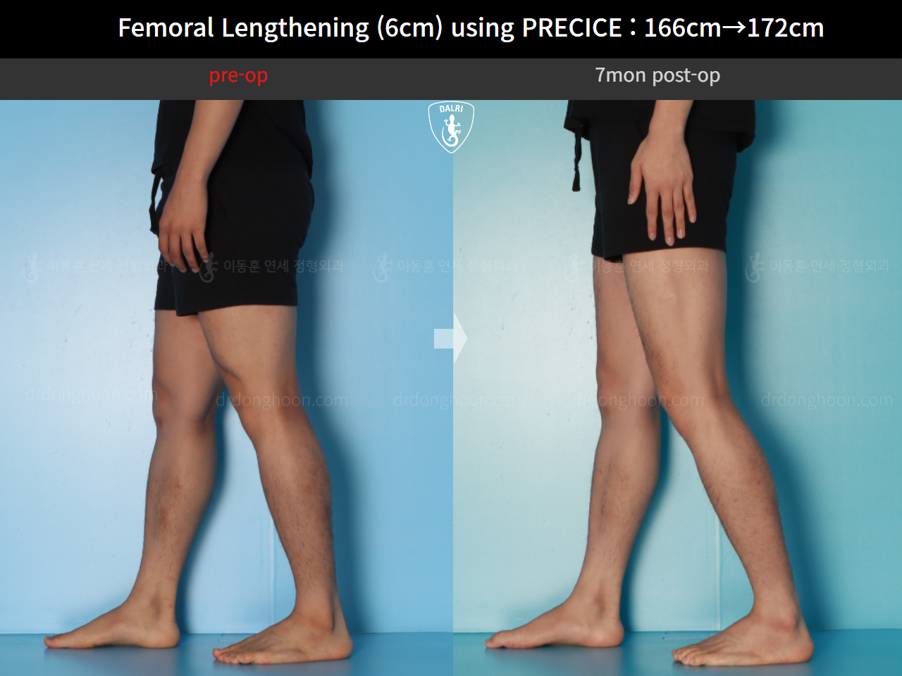 Before and after cll precice, case 17579263, image 7, Dr. Donghoon institute (DALRI)