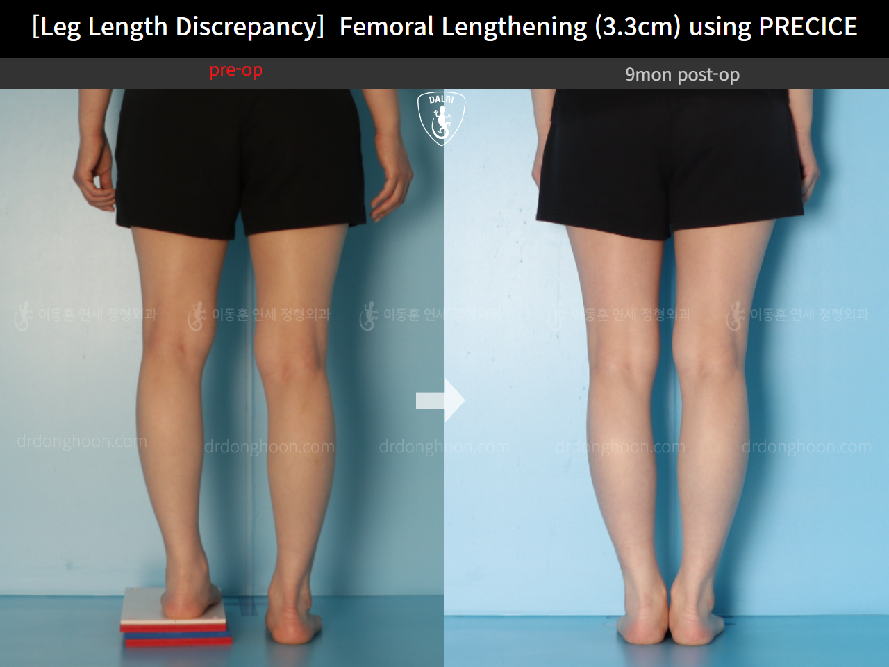 Before and after adult lld, case 14602297, image 6, Dr. Donghoon institute (DALRI)