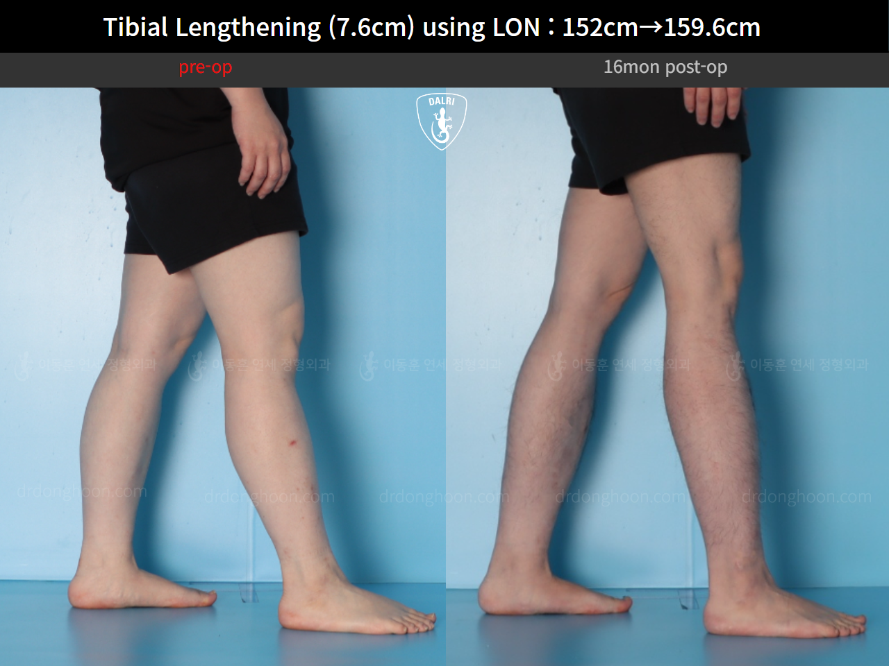 Before and after cll lon, case 123804178, image 8, Dr. Donghoon institute (DALRI)