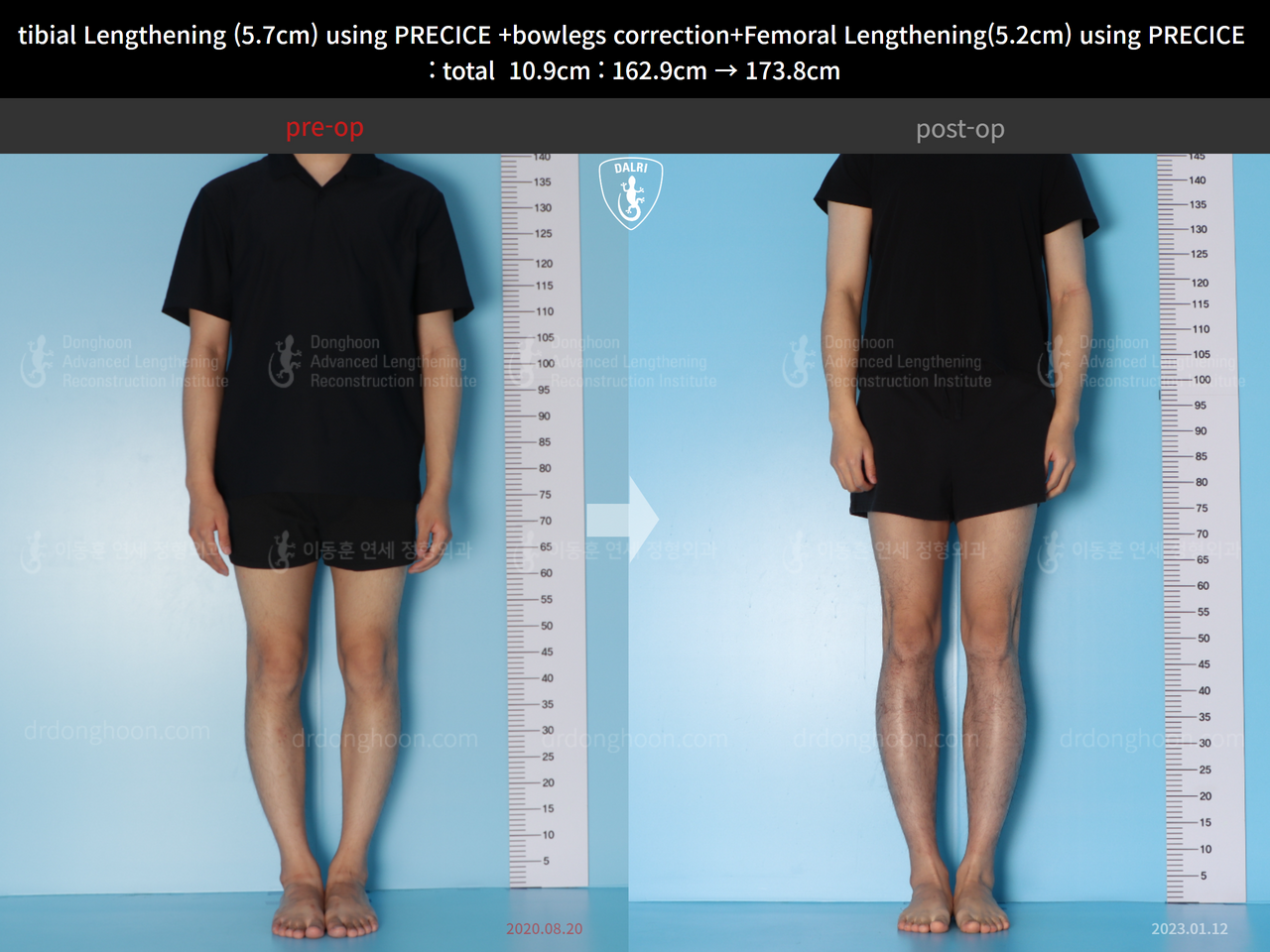 Before and after cll + deformity correction, case 13924912, image 1, Dr. Donghoon institute (DALRI)
