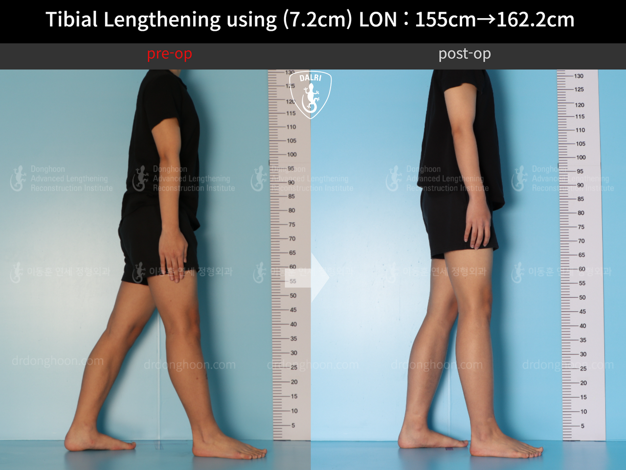 Before and after cll lon, case 13635674, image 5, Dr. Donghoon institute (DALRI)