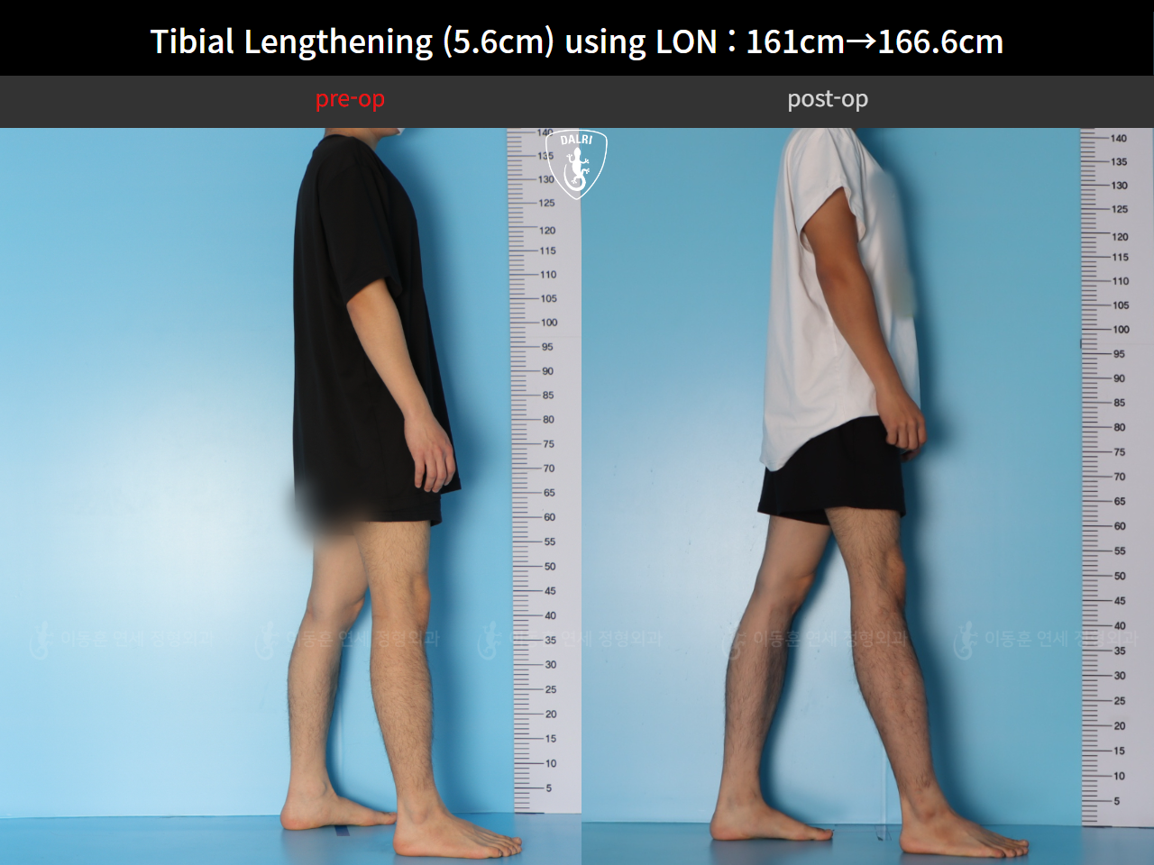 Before and after cll lon, case 126542150, image 4, Dr. Donghoon institute (DALRI)